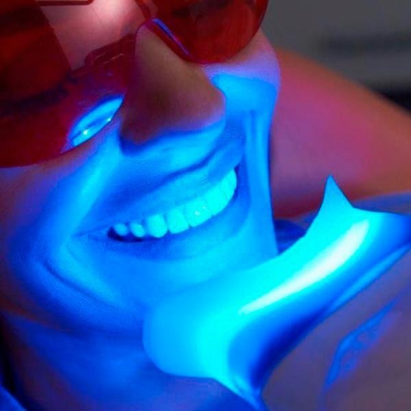Blanqueamiento Dental