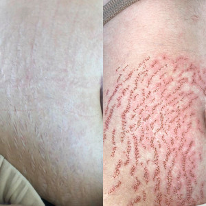 Tratamiento para Reducción de Estrías