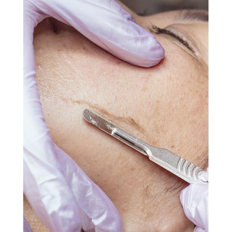 Dermaplaning