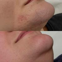 Depilación / Depilación