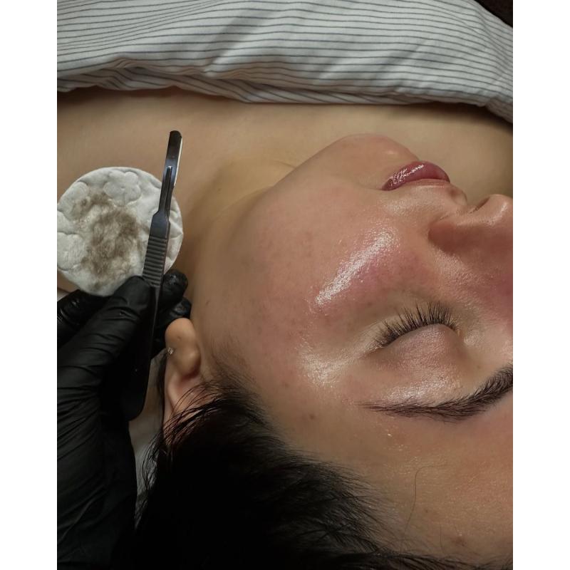 Dermaplaning