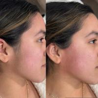 Depilación / Depilación