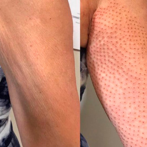 Tratamiento para Recoger Tegidos Blandos